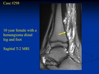 Case #298




10 year female with a
hemangioma distal
leg and foot

Sagittal T-2 MRI
 