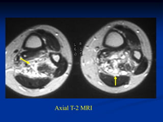 Axial T-2 MRI
 
