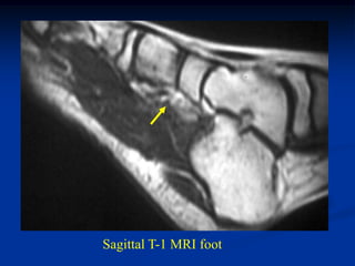 Sagittal T-1 MRI foot
 