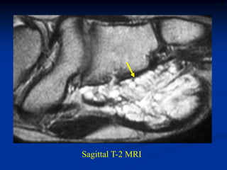 Sagittal T-2 MRI
 