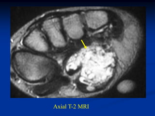 Axial T-2 MRI
 