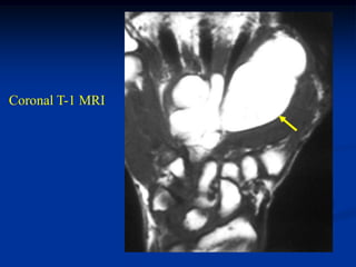 Coronal T-1 MRI
 
