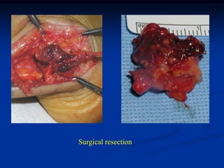 Surgical resection
 