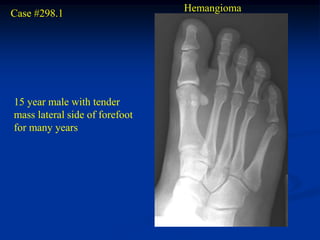 Hemangioma
Case #298.1




15 year male with tender
mass lateral side of forefoot
for many years
 