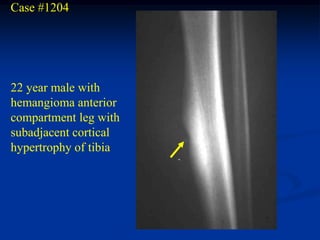 Case #1204




22 year male with
hemangioma anterior
compartment leg with
subadjacent cortical
hypertrophy of tibia
 