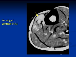 Axial gad
contrast MRI
 
