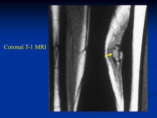 Coronal T-1 MRI
 