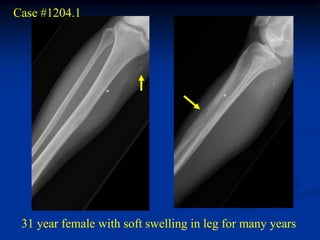 Case #1204.1




 31 year female with soft swelling in leg for many years
 