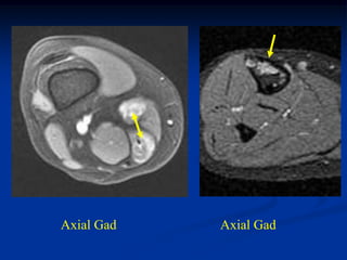 Axial Gad   Axial Gad
 