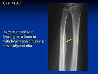 Case #1205




38 year female with
hemangioma forearm
with hypertrophic response
in subadjacent ulna
 