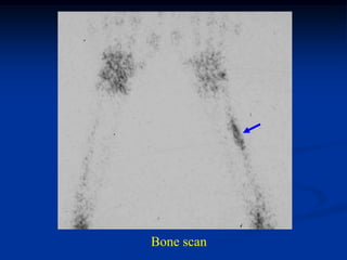 Bone scan
 