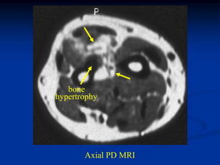 bone
hypertrophy




       Axial PD MRI
 