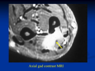 Axial gad contrast MRI
 