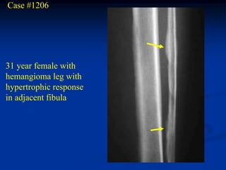 Case #1206




31 year female with
hemangioma leg with
hypertrophic response
in adjacent fibula
 