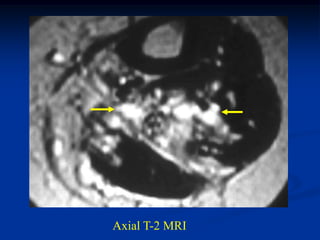 Axial T-2 MRI
 
