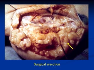 Surgical resection
 