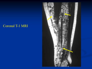 Coronal T-1 MRI
 