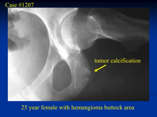 Case #1207




                                tumor calcification




     25 year female with hemangioma buttock area
 