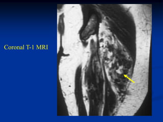 Coronal T-1 MRI
 