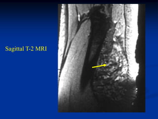 Sagittal T-2 MRI
 