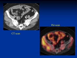 Pet scan


CT scan
 