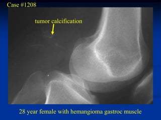 Case #1208

         tumor calcification




    28 year female with hemangioma gastroc muscle
 
