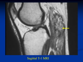 Sagittal T-1 MRI
 