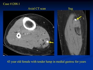 Case #1208.1
                  Axial CT scan                   Sag




  43 year old female with tender lump in medial gastroc for years
 