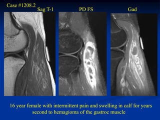 Case #1208.2
               Sag T-1            PD FS                  Gad




 16 year female with intermittent pain and swelling in calf for years
           second to hemagioma of the gastroc muscle
 