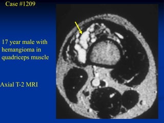 Case #1209




17 year male with
hemangioma in
quadriceps muscle



Axial T-2 MRI
 