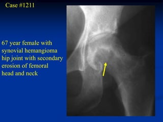 Case #1211




67 year female with
synovial hemangioma
hip joint with secondary
erosion of femoral
head and neck
 