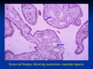 Synovial biopsy showing numerous vascular spaces
 