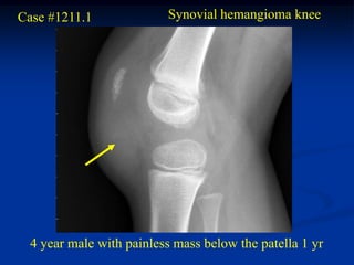 Case #1211.1              Synovial hemangioma knee




  4 year male with painless mass below the patella 1 yr
 