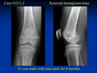 Case #1211.2               Synovial hemagioma knee




       15 year male with knee pain for 6 months
 