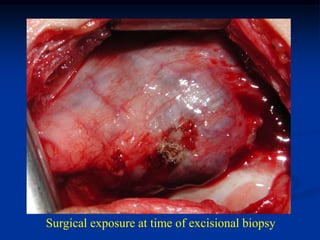 Surgical exposure at time of excisional biopsy
 