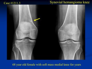Case #1211.3                        Synovial hemangioma knee




      68 year old female with soft mass medial knee for years
 