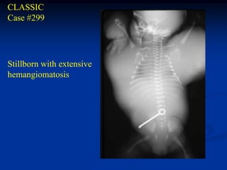 CLASSIC
Case #299




Stillborn with extensive
hemangiomatosis
 