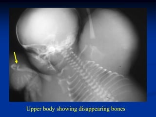 Upper body showing disappearing bones
 