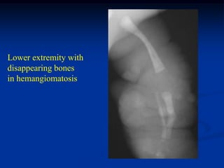 Lower extremity with
disappearing bones
in hemangiomatosis
 