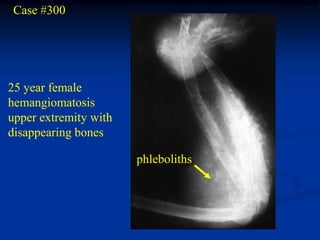 Case #300




25 year female
hemangiomatosis
upper extremity with
disappearing bones

                       phleboliths
 