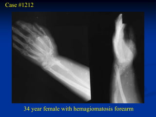Case #1212




                         phleboliths




      34 year female with hemagiomatosis forearm
 