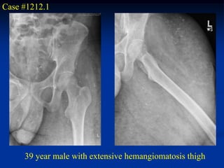 Case #1212.1




     39 year male with extensive hemangiomatosis thigh
 