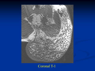 Coronal T-1
 