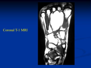 Coronal T-1 MRI
 