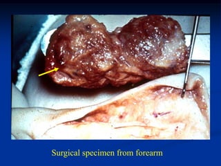 Surgical specimen from forearm
 