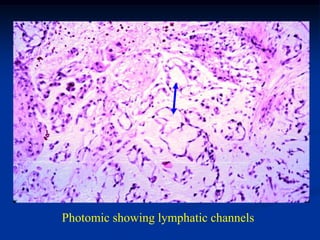 Photomic showing lymphatic channels
 