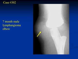 Case #302




7 month male
lymphangioma
elbow
 