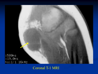 Coronal T-1 MRI
 
