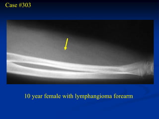 Case #303




      10 year female with lymphangioma forearm
 