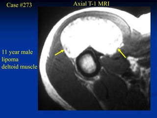 Case #273       Axial T-1 MRI




11 year male
lipoma
deltoid muscle
 